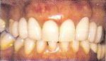 имплантация в Самаре, зубные имплантанты и протезы