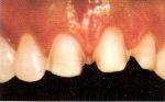 Имплантация Самара, зубные имплантанты, протезы на имплантантах
